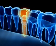Illustration of an X-ray with a dental implant and crown