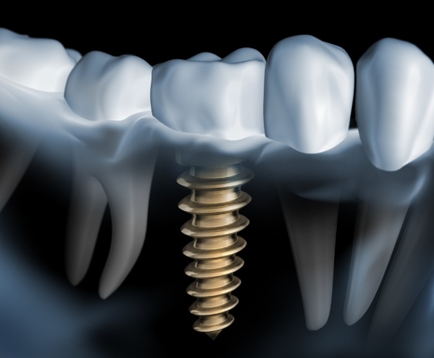 Model dental implant supported dental crown