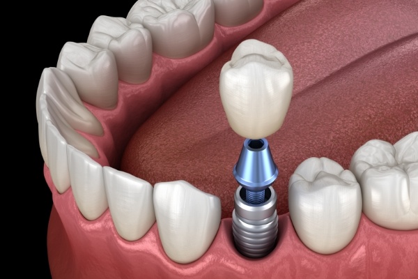 Animated smile during dental implant supported fixed bridge placement
