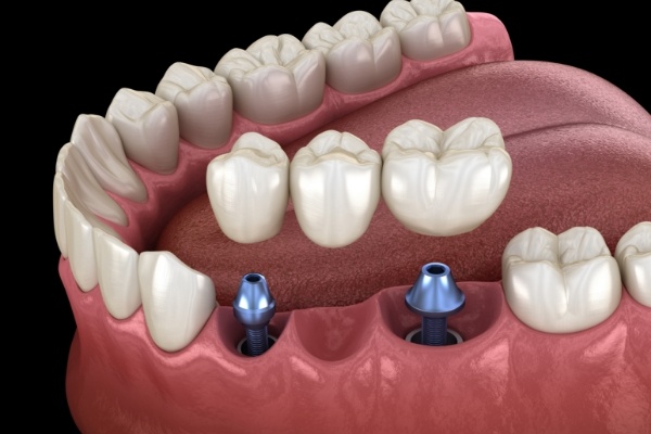 Animated smile after dental implant supported denture placement