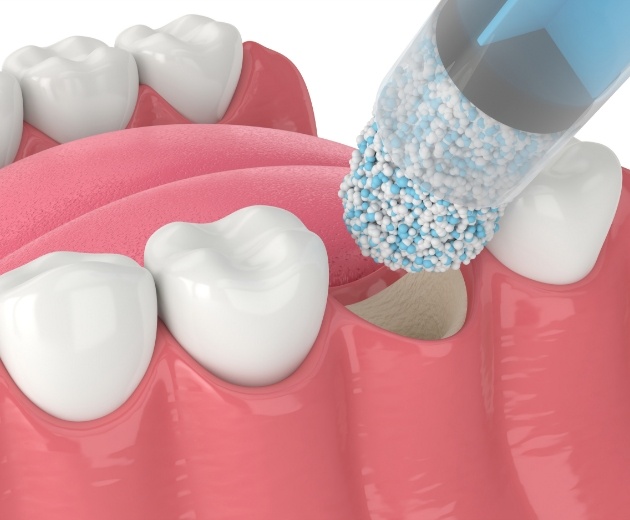 Animated smile after bone grafting