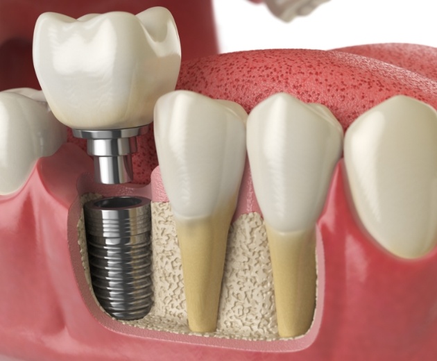 Animated facial profile with dental implant supported dental crown
