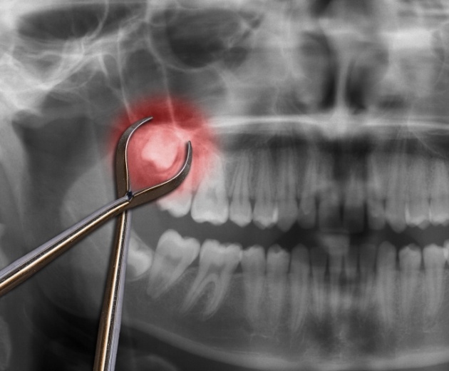 Animated row of teeth with impacted wisdom tooth