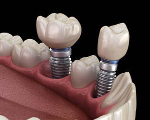 Two dental implants being inserted into lower jaw