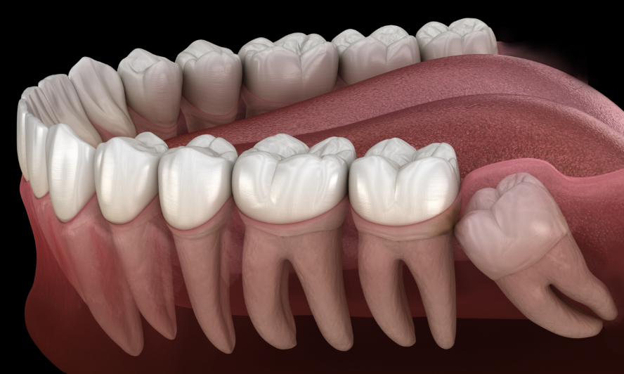 Wisdom teeth cross section