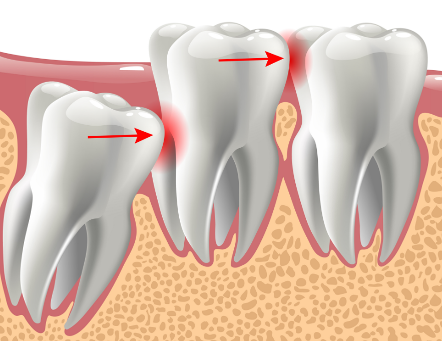 Wisdom tooth illustration